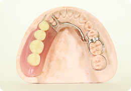 部分入れ歯