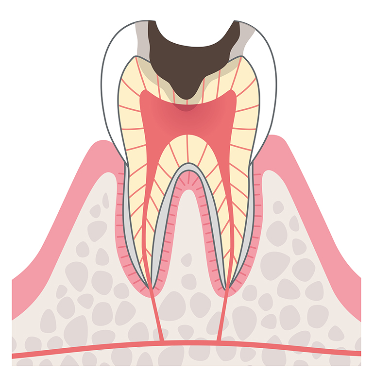 象牙質まで進行したむし歯