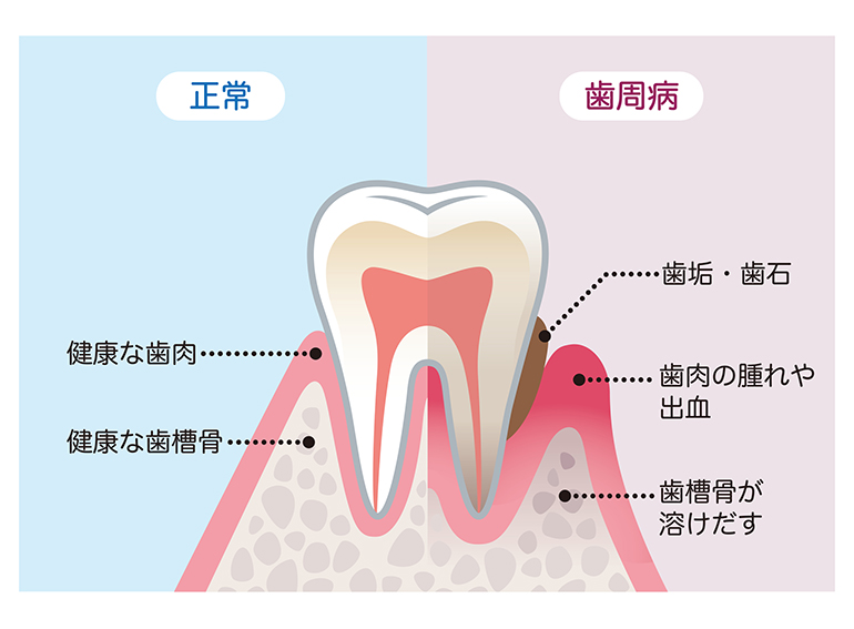 そもそも歯周病って何？